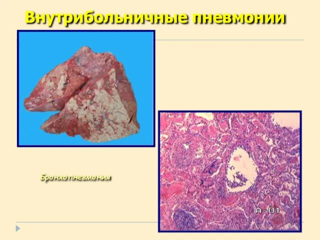 Бронхопневмония Внутрибольничные пневмонии