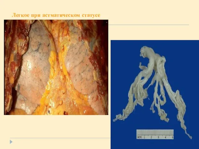 Легкое при астматическом статусе