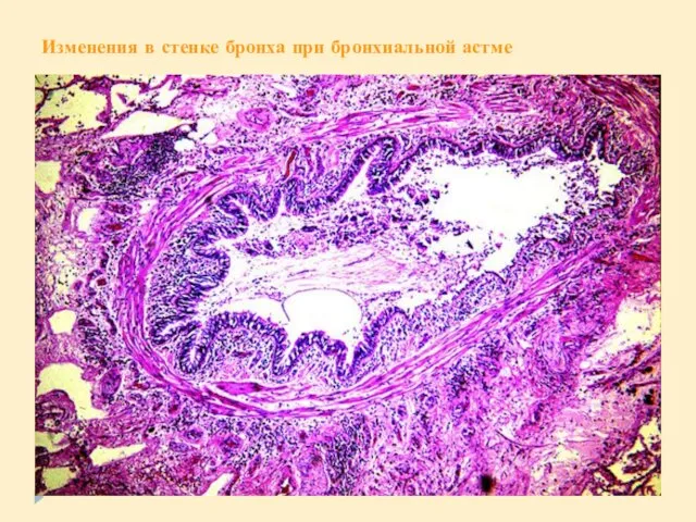 Изменения в стенке бронха при бронхиальной астме