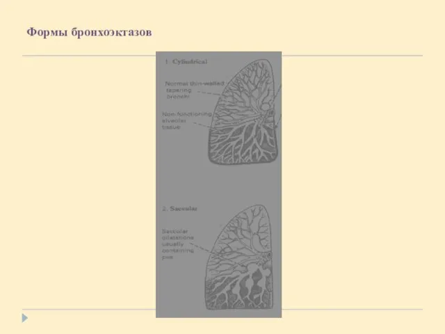 Формы бронхоэктазов