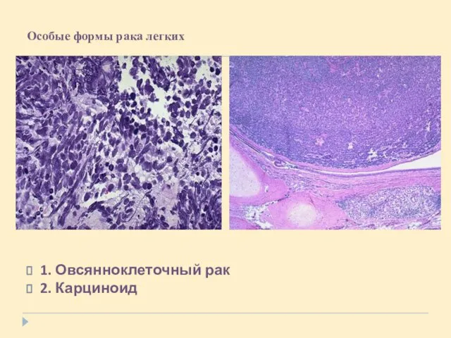 Особые формы рака легких 1. Овсянноклеточный рак 2. Карциноид