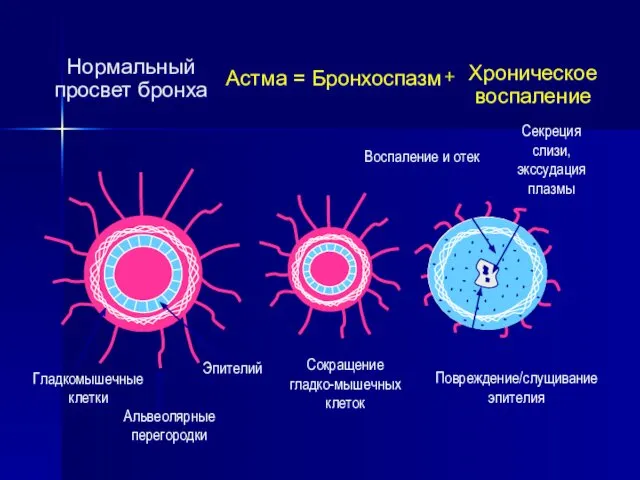 Гладкомышечные клетки Эпителий Альвеолярные перегородки Сокращение гладко-мышечных клеток Повреждение/слущивание эпителия Секреция