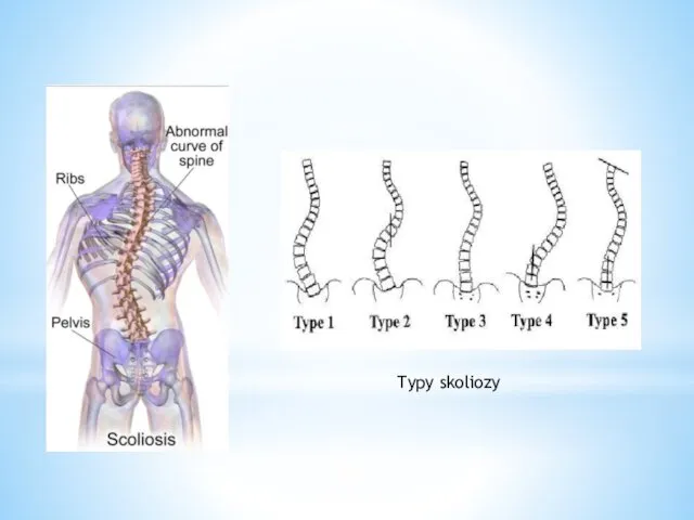 Typy skoliozy