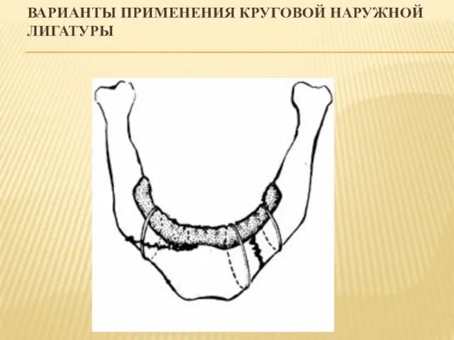 ВАРИАНТЫ ПРИМЕНЕНИЯ КРУГОВОЙ НАРУЖНОЙ ЛИГАТУРЫ