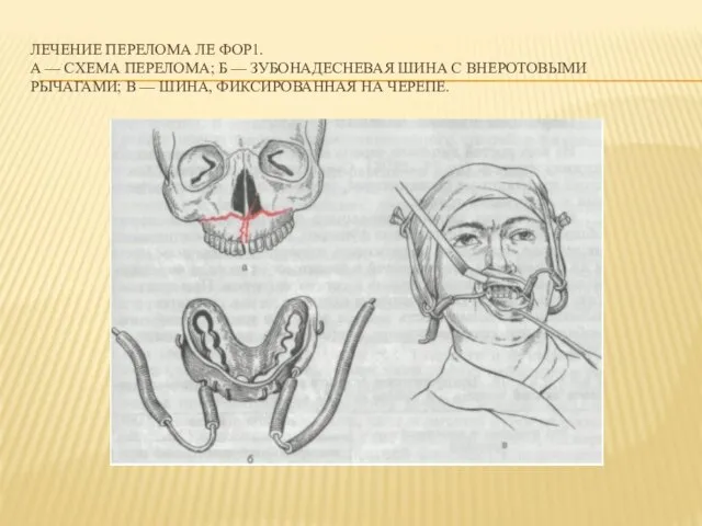 ЛЕЧЕНИЕ ПЕРЕЛОМА ЛЕ ФОР1. А — СХЕМА ПЕРЕЛОМА; Б — ЗУБОНАДЕСНЕВАЯ