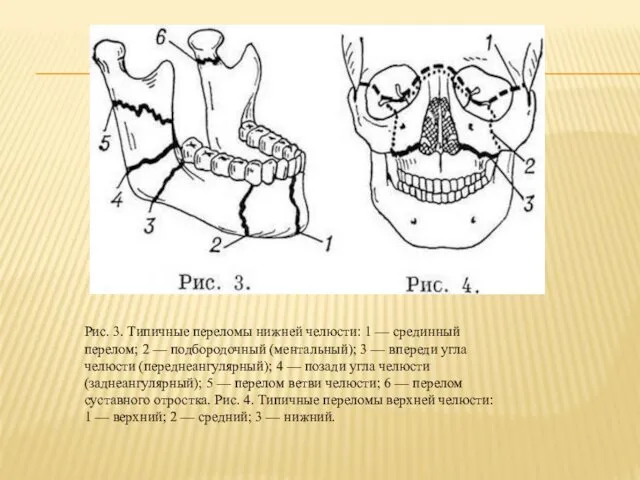 Рис. 3. Типичные переломы нижней челюсти: 1 — срединный перелом; 2