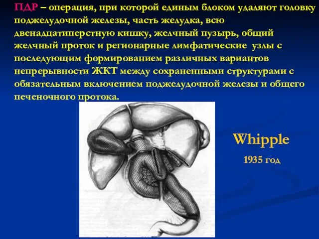 ПДР – операция, при которой единым блоком удаляют головку поджелудочной железы,