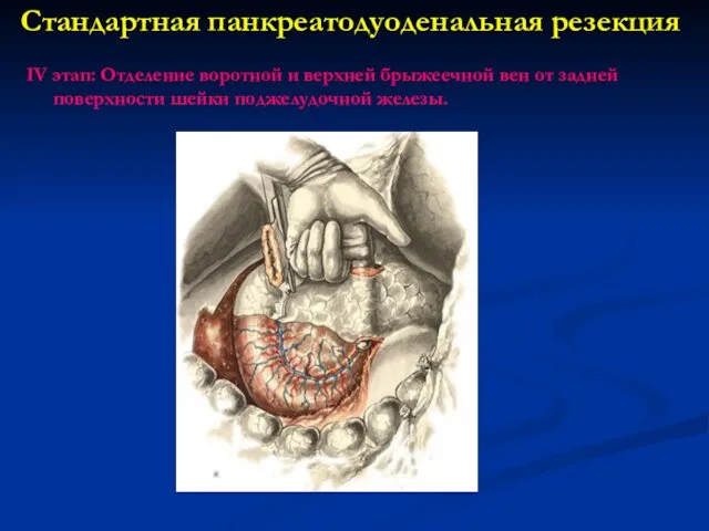 Стандартная панкреатодуоденальная резекция IV этап: Отделение воротной и верхней брыжеечной вен