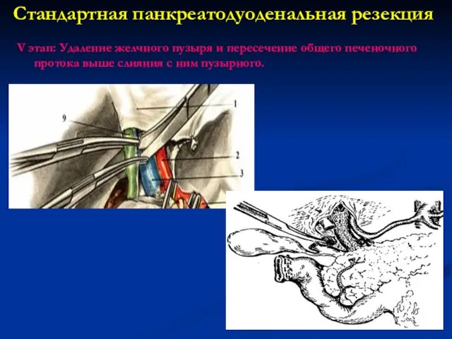 Стандартная панкреатодуоденальная резекция V этап: Удаление желчного пузыря и пересечение общего