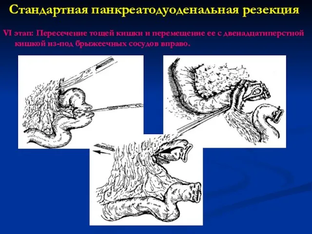 VI этап: Пересечение тощей кишки и перемещение ее с двенадцатиперстной кишкой