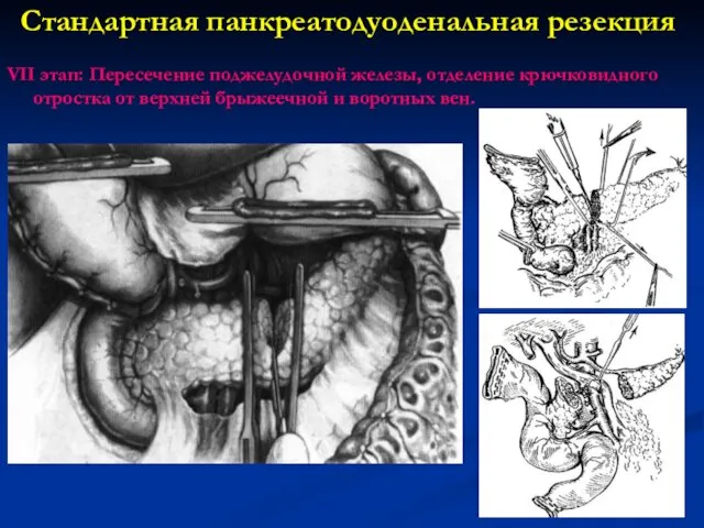 Стандартная панкреатодуоденальная резекция VII этап: Пересечение поджелудочной железы, отделение крючковидного отростка