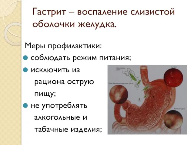 Гастрит – воспаление слизистой оболочки желудка. Меры профилактики: соблюдать режим питания;