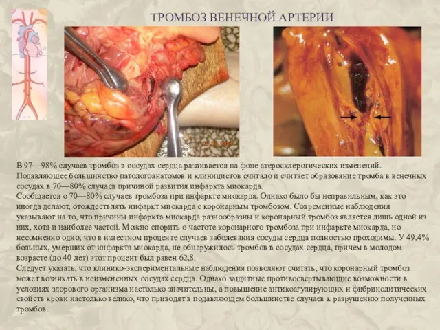 ТРОМБОЗ ВЕНЕЧНОЙ АРТЕРИИ В 97—98% случаев тромбоз в сосудах сердца развивается