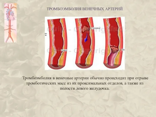 ТРОМБОЭМБОЛИЯ ВЕНЕЧНЫХ АРТЕРИЙ Тромбоэмболия в венечные артерии обычно происходит при отрыве