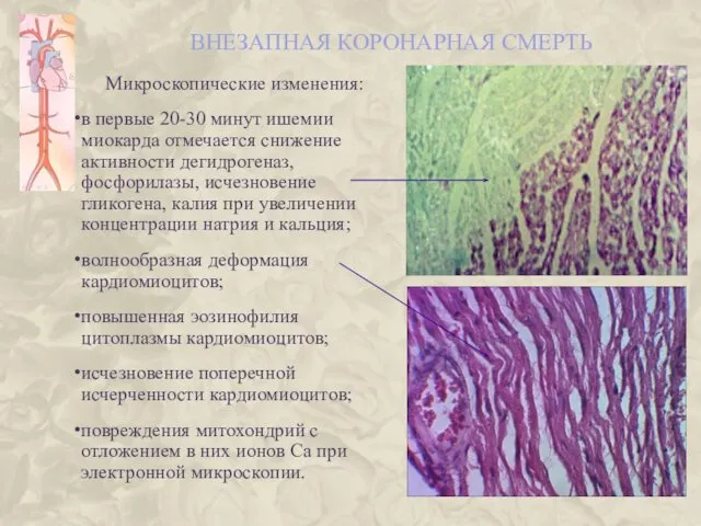 ВНЕЗАПНАЯ КОРОНАРНАЯ СМЕРТЬ Микроскопические изменения: в первые 20-30 минут ишемии миокарда