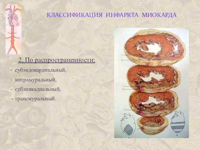 КЛАССИФИКАЦИЯ ИНФАРКТА МИОКАРДА 2. По распространенности: - субэндокардиальный, - интрамуральный, - субэпикадиальный, - трансмуральный.