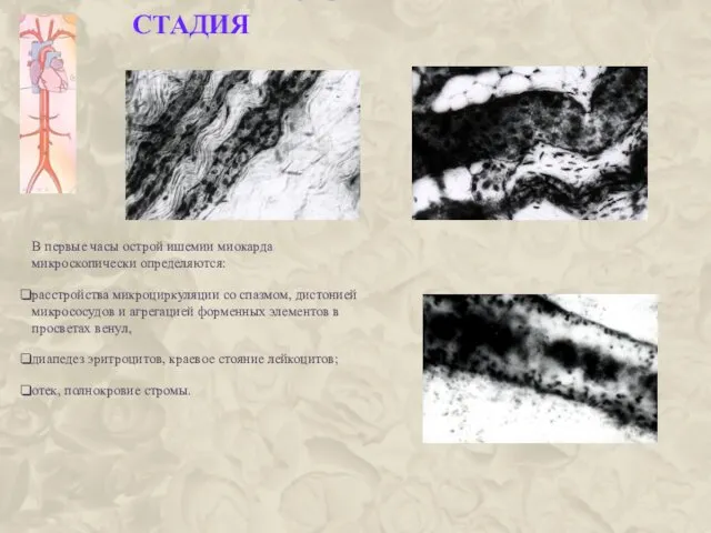 ИШЕМИЧЕСКАЯ СТАДИЯ В первые часы острой ишемии миокарда микроскопически определяются: расстройства