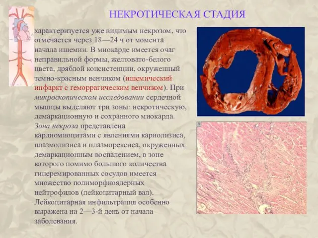 НЕКРОТИЧЕСКАЯ СТАДИЯ характеризуется уже видимым некрозом, что отмечается через 18—24 ч