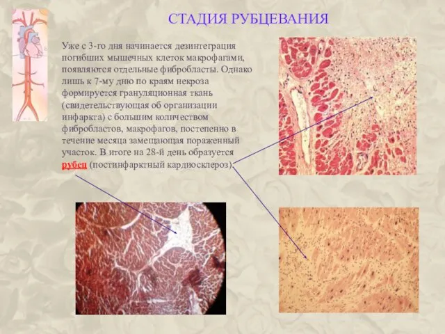 СТАДИЯ РУБЦЕВАНИЯ Уже с 3-го дня начинается дезинтеграция погибших мышечных клеток