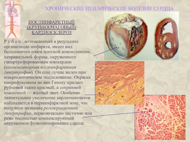 ХРОНИЧЕСКИЕ ИШЕМИЧЕСКИЕ БОЛЕЗНИ СЕРДЦА ПОСТИНФАРКТНЫЙ (КРУПНООЧАГОВЫЙ) КАРДИОСКЛЕРОЗ Р у б е