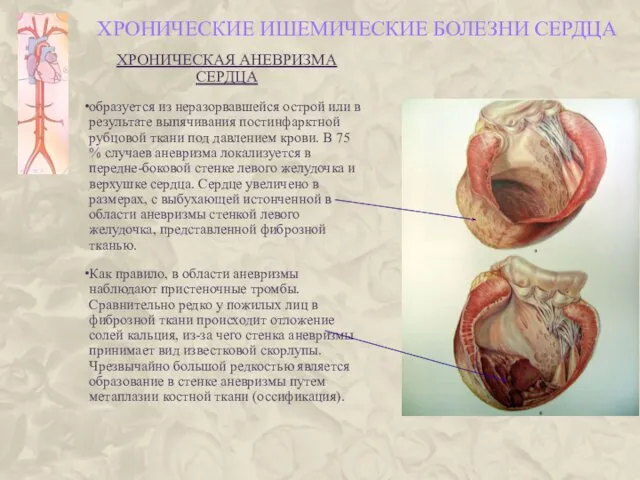 ХРОНИЧЕСКИЕ ИШЕМИЧЕСКИЕ БОЛЕЗНИ СЕРДЦА ХРОНИЧЕСКАЯ АНЕВРИЗМА СЕРДЦА образуется из неразорвавшейся острой