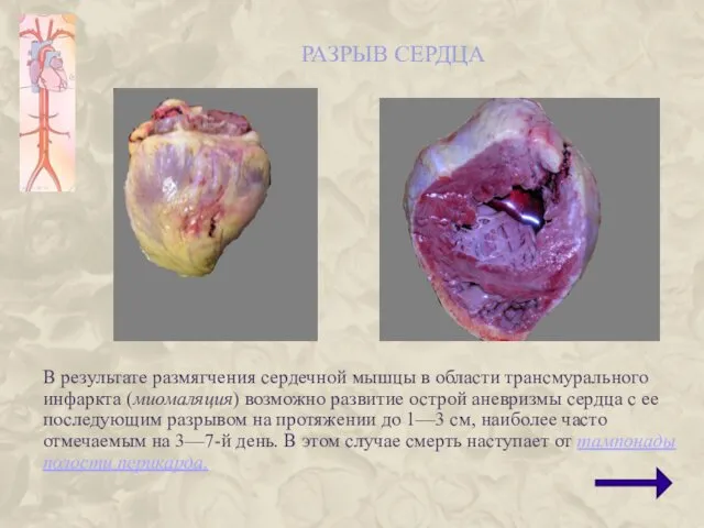 РАЗРЫВ СЕРДЦА В результате размягчения сердечной мышцы в области трансмурального инфаркта