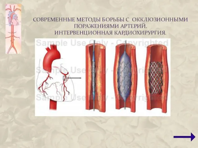 СОВРЕМЕННЫЕ МЕТОДЫ БОРЬБЫ С ОККЛЮЗИОННЫМИ ПОРАЖЕНИЯМИ АРТЕРИЙ. ИНТЕРВЕНЦИОННАЯ КАРДИОХИРУРГИЯ.