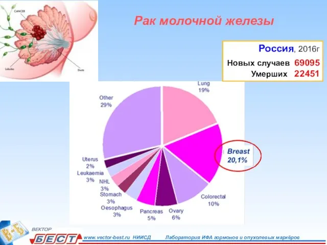 Рак молочной железы Россия, 2016г Новых случаев 69095 Умерших 22451