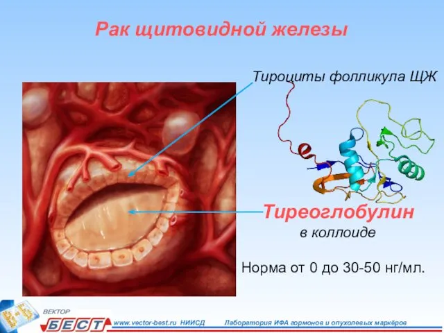 Тиреоглобулин в коллоиде Норма от 0 до 30-50 нг/мл. Тироциты фолликула ЩЖ Рак щитовидной железы