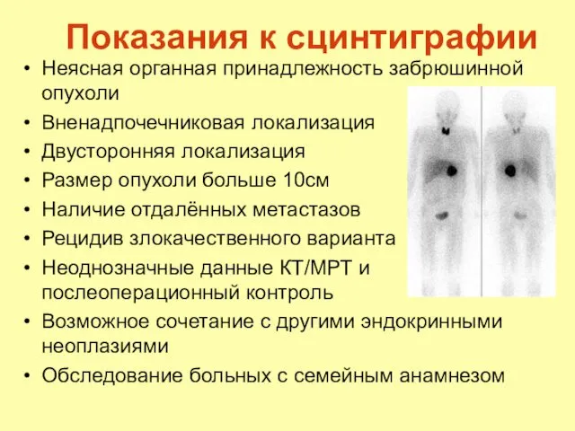 Показания к сцинтиграфии Неясная органная принадлежность забрюшинной опухоли Вненадпочечниковая локализация Двусторонняя