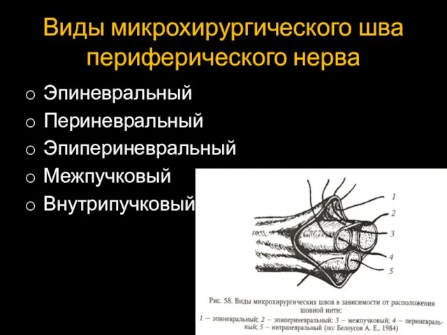 Виды микрохирургического шва периферического нерва Эпиневральный Периневральный Эпипериневральный Межпучковый Внутрипучковый