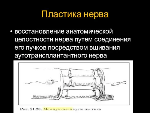 Пластика нерва восстановление анатомической целостности нерва путем соединения его пучков посредством вшивания аутотрансплантантного нерва