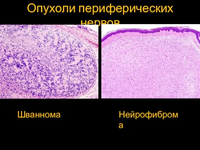 Опухоли периферических нервов Шваннома Нейрофиброма