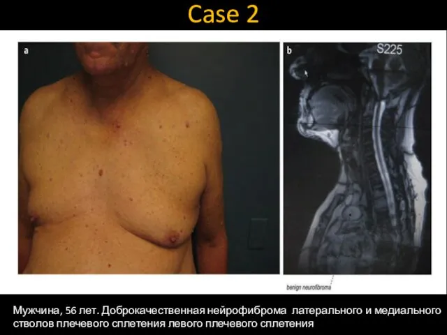 Case 2 Мужчина, 56 лет. Доброкачественная нейрофиброма латерального и медиального стволов плечевого сплетения левого плечевого сплетения