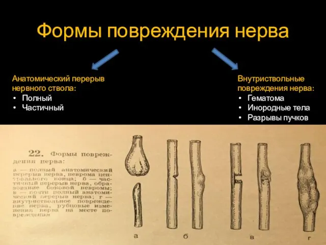 Формы повреждения нерва Анатомический перерыв нервного ствола: Полный Частичный Внутриствольные повреждения