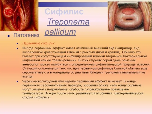 Патогенез Первичный сифилис Иногда первичный аффект имеет атипичный внешний вид (например,