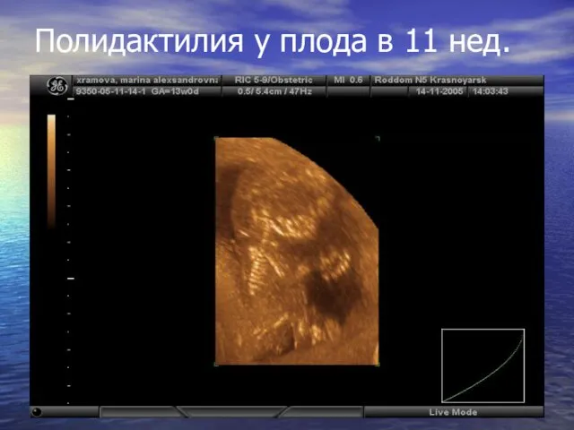 Полидактилия у плода в 11 нед.