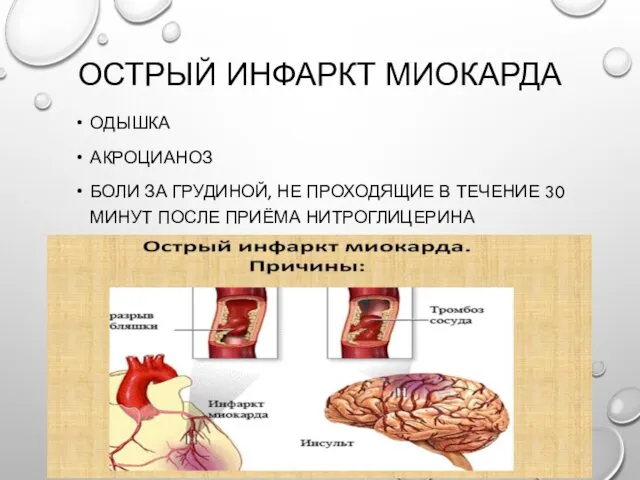 ОСТРЫЙ ИНФАРКТ МИОКАРДА ОДЫШКА АКРОЦИАНОЗ БОЛИ ЗА ГРУДИНОЙ, НЕ ПРОХОДЯЩИЕ В