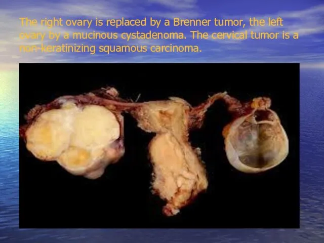 The right ovary is replaced by a Brenner tumor, the left