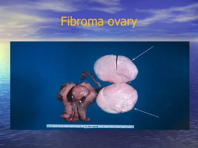 Fibroma ovary