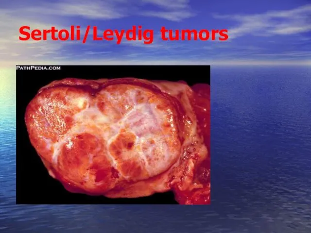 Sertoli/Leydig tumors