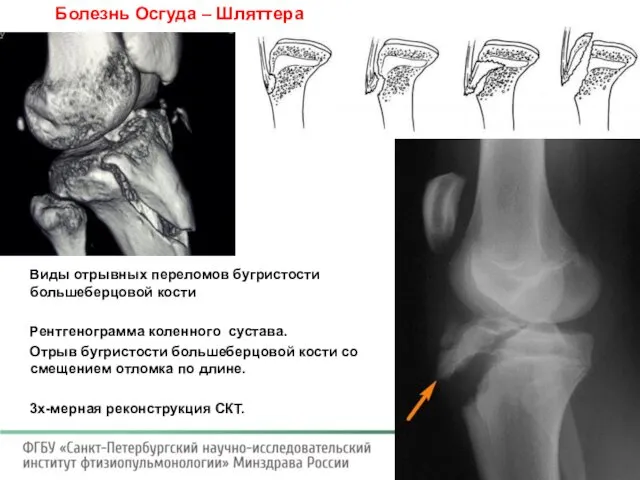 Болезнь Осгуда – Шляттера Виды отрывных переломов бугристости большеберцовой кости Рентгенограмма