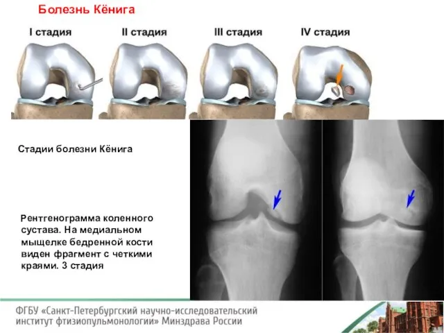 Болезнь Кёнига Стадии болезни Кёнига Рентгенограмма коленного сустава. На медиальном мыщелке