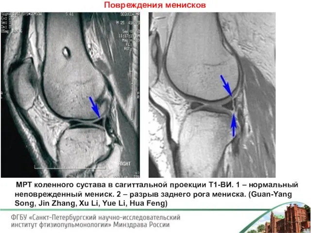 Повреждения менисков МРТ коленного сустава в сагиттальной проекции Т1-ВИ. 1 –