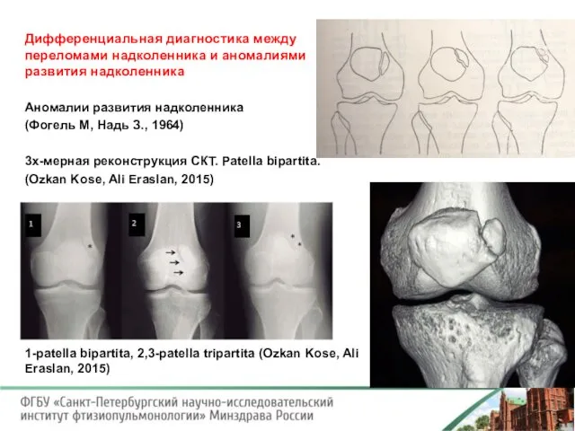 Дифференциальная диагностика между переломами надколенника и аномалиями развития надколенника Аномалии развития