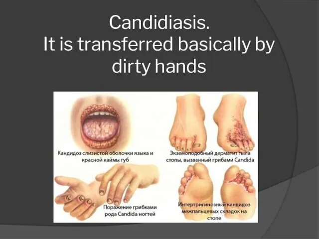 Candidiasis. It is transferred basically by dirty hands