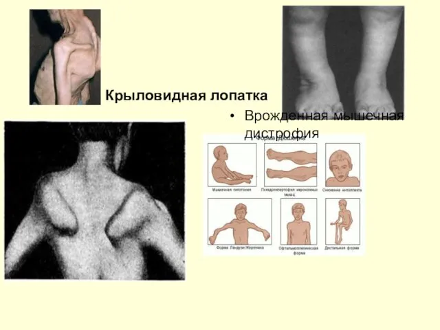 Крыловидная лопатка Врожденная мышечная дистрофия