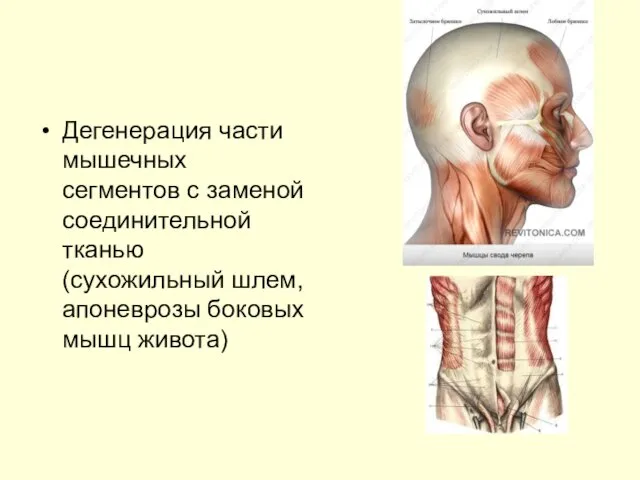 Дегенерация части мышечных сегментов с заменой соединительной тканью (сухожильный шлем, апоневрозы боковых мышц живота)