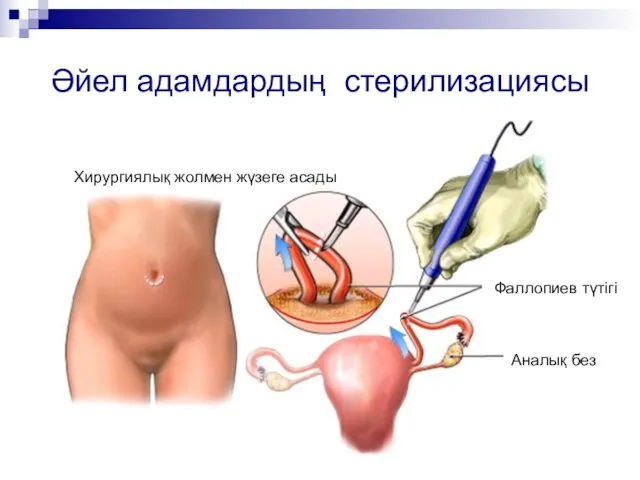 Әйел адамдардың стерилизациясы Хирургиялық жолмен жүзеге асады Фаллопиев түтігі Аналық без