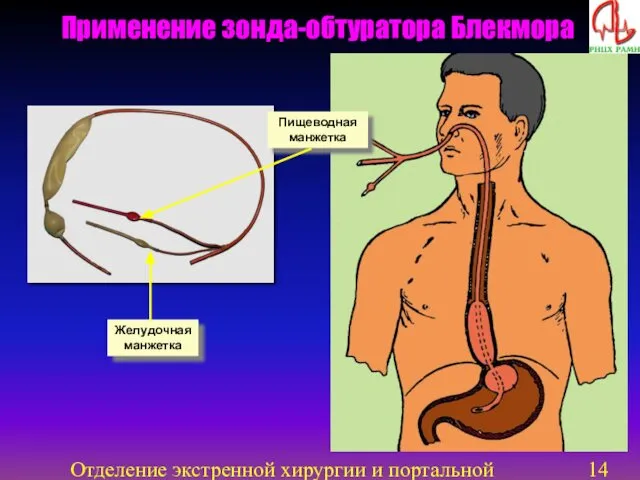 Отделение экстренной хирургии и портальной гипертензии Пищеводная манжетка Желудочная манжетка Применение зонда-обтуратора Блекмора